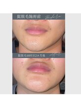 レオナルド(Leonardo)/ヒゲ脱毛は肌も明るくなります！