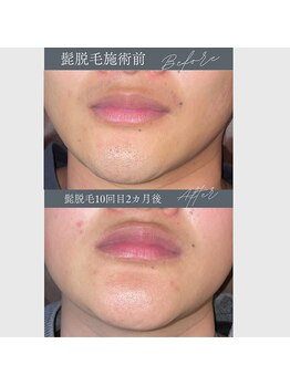 レオナルド(Leonardo)/ヒゲ脱毛は肌も明るくなります!