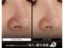 メディケア 新宿/ENVIRON フルコース【毛穴】