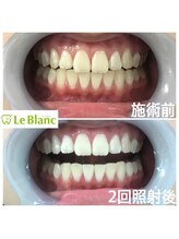 ルブラン 奈良店(Le Blanc)/ご紹介でお得にホワイトニング