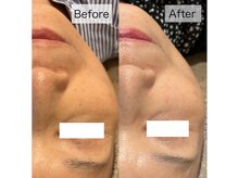 フイユ(feuille)/UNSTRESS1回＋ILLUSTRIOUS1回