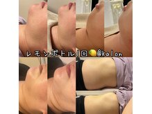 プラズマ&レモンボトルの最強lコンビで1回でもこの位の変化あり