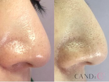 キャンディ 岐阜(CANDi)/ハイドラピーリング/黒ずみ毛穴