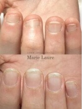 マリーロール 梅田店(Marie Laure)/自爪育成/深爪矯正/ネイルケア