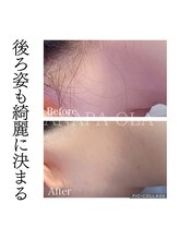 アナパ・オラ/脱毛