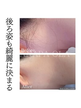 アナパ・オラ/脱毛