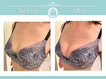 美人バスト 表参道店/ 【バストアップ/育乳 症例】