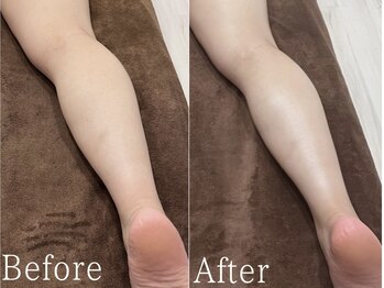 サージュクロレ 松戸店(sage colorer)/ハイパーナイフ痩身