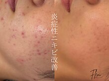 繰り返す肌荒れはピーリングと皮膚細胞の強化で解決◎