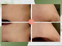 【背中ニキビ・跡ケア特化ハーブピーリング】見せたくなる背中に