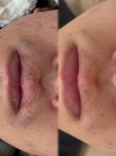 アトリーチェ ベレッツァ(ATTRICE Bellezza)/顎までまるごとヒゲ脱毛