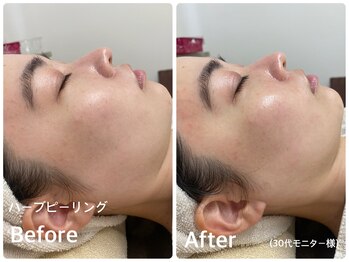 ラウレア(LAULEA)/ハーブピーリングBefore/After