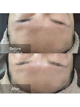 アイ(I)/眉間のしわたるみ改善