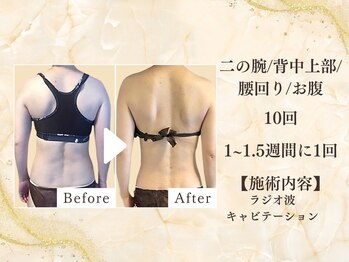 ミスティア(mistia)/【セルフエステBA】上半身