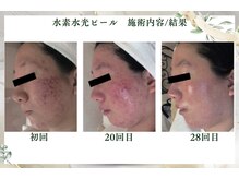 サロンドエクラ 南堀江(salon de eclat)/水素水光ピール