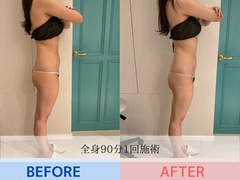 エル 麻布十番(LllL)/【痩身】90分1回の効果