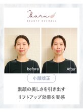 イカル 池袋(ikaru)/小顔矯正 before after 