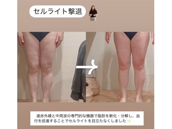 トトノエル(TOTONOEL)/脚のセル＆脂肪ケア