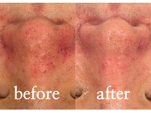 ボヌール(bonheur)/毛穴レス＆ニキビ改善