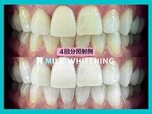 ミルクホワイトニング 久留米店(Milkホワイトニング)/★施術例