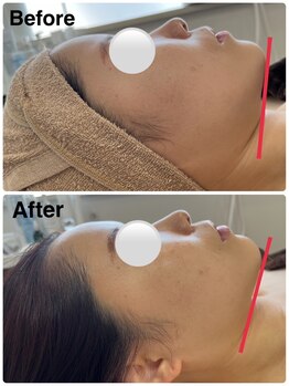 ミセル(MISEL2nd)/シュッとした輪郭に★小顔ケア