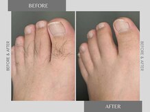 テリー(Terry)/メンズ脱毛before after 5回照射