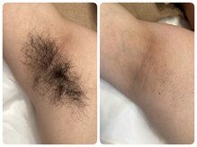 クリア 尾張旭店(Clear)/【Clear脱毛ビフォーアフター】