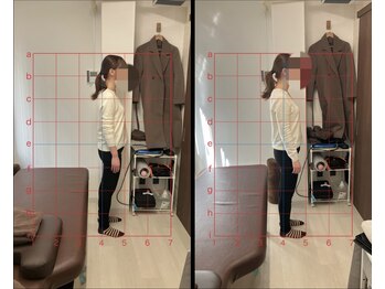 とるこり美姿整体院 新宿院/ 20代女性-姿勢矯正 1ヶ月経過