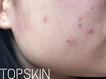 トップスキン 名駅(TOPSKIN)/30代繰り返す大人ニキビも改善♪
