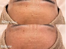 シャルム(Charme)/メンズフェイシャル♪シワケア