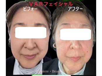 リュミエールボーテ/《NEW！》ＶＡＲフェイシャル