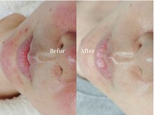 ヴィヴァンビー(Vivant+B)/before /after