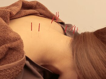 ナラワ(NARAWA)/鍼灸施術でストレス解消☆☆