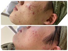 イネスプライベートスペース(Ines)の雰囲気（アクネ菌・ニキビケア特化店（男性も含む）　6回　４か月経過）