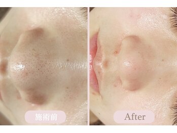 エピル(EPIL)/ララピール＋毛穴洗浄症例