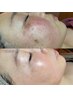 全顔徹底【しみケア】　隠す肌から透明感のある見せる肌へ☆