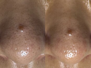 サラグランデ(Sara Grande)/毛穴の大掃除