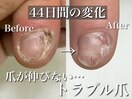 伸びない爪の変化