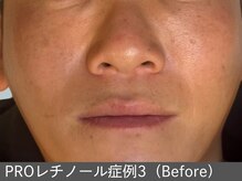 オアシスラグーン(OASIS LAGOON)/レチノール（症例3 before）