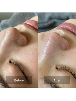 スリーピーオーブ(Sleepy Orb)の写真/ブライダルもOK♪熟練の技★Orb式4D毛穴洗浄なら1度でここまで効果実感!ハーブピーリングで毛穴引き締め◎
