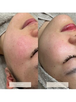 タグ 高知駅前店(Tug)/頬の赤・毛穴開き