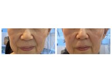 シャンディ(Shandy)/松ヤニエステ