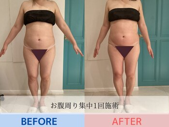 エル 麻布十番(LllL)/【痩身】お腹周り集中1回の効果