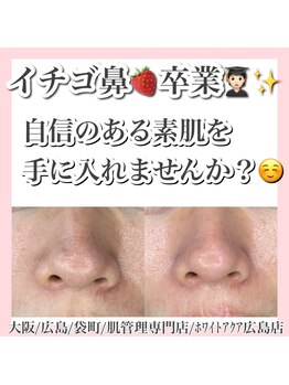 ホワイトアクア 広島店(WHITE AQUA)/ララピール/毛穴/ニキビケア