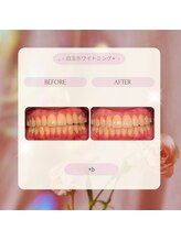 プラスビーセルフ(+b self)/ホワイトニングビフォーアフター