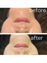 レイモード(Ray mode)/BBLフェイシャル＆パック