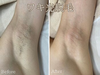 シエナ(ciena)/ワキ脱毛