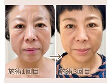 ルビーミー(Ruby's Me)/美顔筋テラボーラー症例