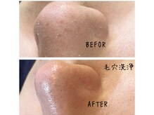メンズプシュケ(men's PSYCHE)/毛穴洗浄