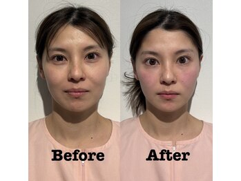 マホロバ(mahoroba)/美容鍼で小顔美肌